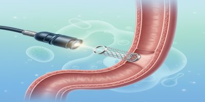Yemek Borusuna Stent Takılması (Özofagus Stent): Endoskopik Stent Uygulaması