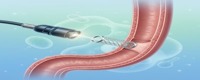 Yemek Borusuna Stent Takılması (Özofagus Stent): Endoskopik Stent Uygulaması