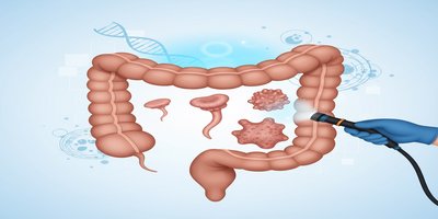 Kolon Polipleri Nedir? Polip Belirtileri ve Tedavisi