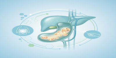 Safra Kesesi Taşları Nedir? Safra Taşı Belirtileri ve Tedavisi