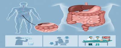 Kolonoskopi Nedir? Kolonoskopi Nasıl Yapılır? Hazırlık Süreci (Adım Adım Rehber)