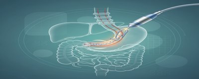GERDX Reflü Tedavisi Nedir? Endoskopik (Ameliyatsız) Reflü Tedavi Yöntemi