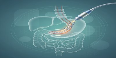 GERDX Reflü Tedavisi Nedir? Endoskopik (Ameliyatsız) Reflü Tedavi Yöntemi